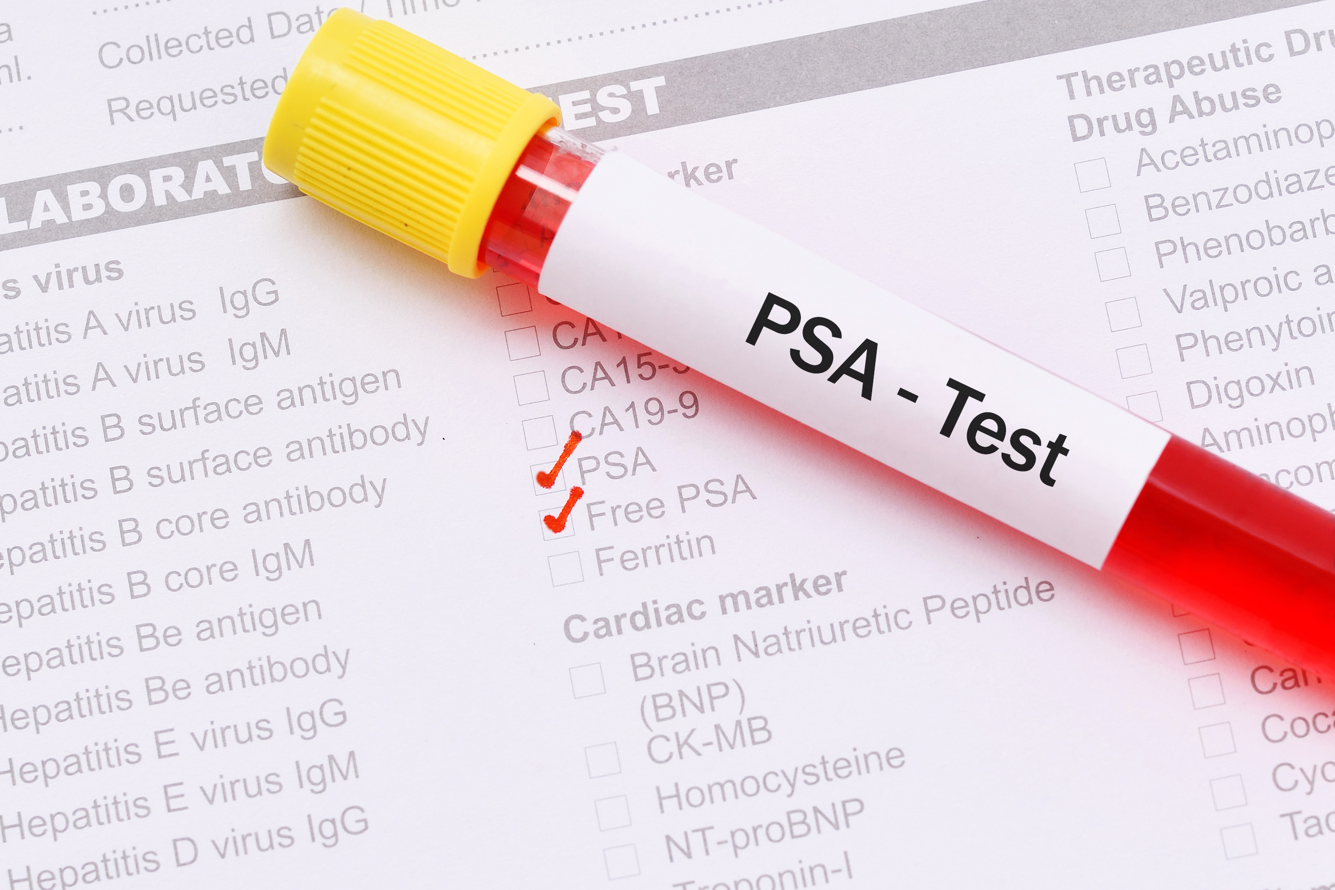 PSA testing